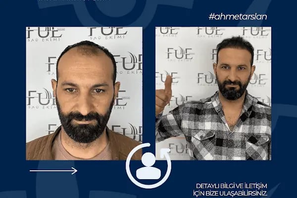 Ahmet Arslan Hair Transplant - Ankara Saç Ekimi - PRP - Resim 14
