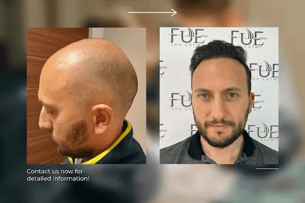 Ahmet Arslan Hair Transplant - Ankara Saç Ekimi - PRP - Resim 12