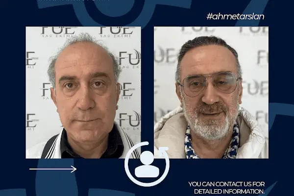 Ahmet Arslan Hair Transplant - Ankara Saç Ekimi - PRP - Resim 18