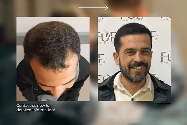Ahmet Arslan Hair Transplant - Ankara Saç Ekimi - PRP - Resim 8