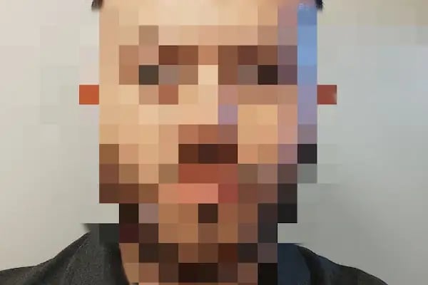 Ahmet Arslan Hair Transplant - Ankara Saç Ekimi - PRP - Resim 5