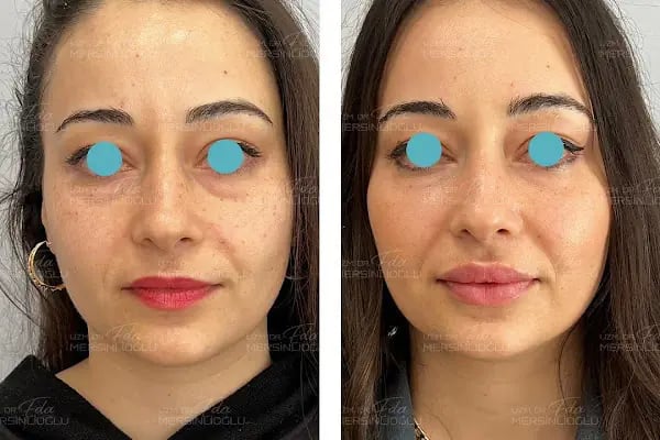 Uzm.Dr.Eda Özkara Mersinlioğlu - Dudak Dolgusu - Burun Dolgusu - Botoks - Gençlik Aşısı - Eksozom Tedavisi - Saç Mezoterapisi - Resim 20