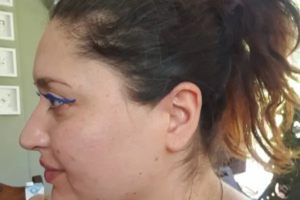 Uzm.Dr.Eda Özkara Mersinlioğlu - Dudak Dolgusu - Burun Dolgusu - Botoks - Gençlik Aşısı - Eksozom Tedavisi - Saç Mezoterapisi - Resim 10