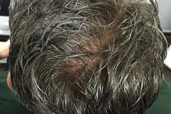 Frenchair Trabzon Saç Protezi Merkezi - Resim 15