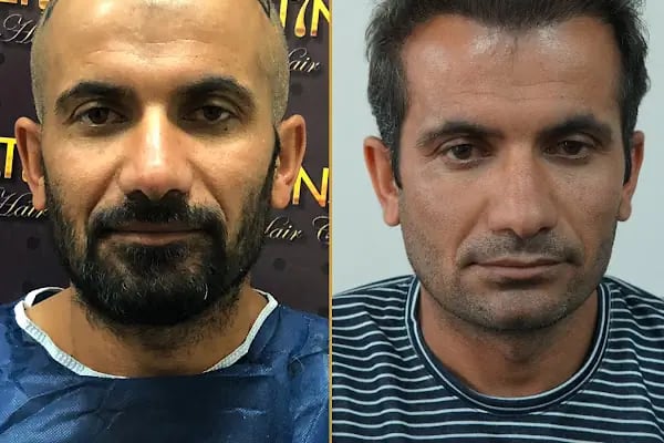 Erzurum Saç Ekim Merkezi Saç PRP`si | Altınsoy Hair Clinic - Resim 6