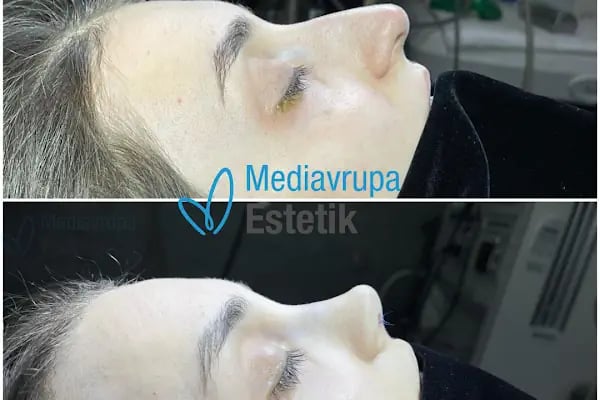MediAvrupa Estetik / Burun Estetiği / Meme Estetiği / Popo Estetiği (BBL) /Liposuction/ Karın Germe/ MOMMY MAKEOVER/ - Resim 16
