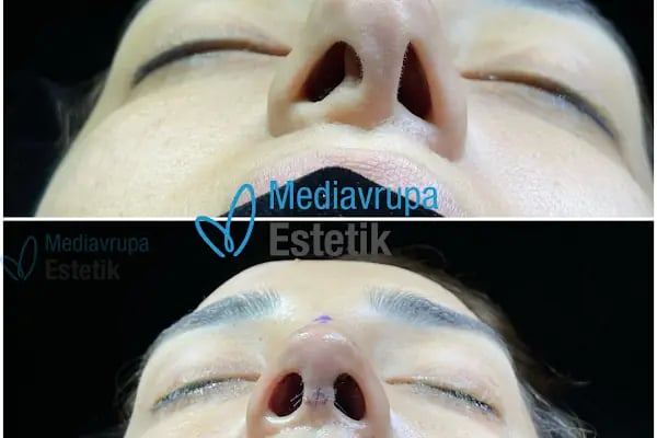 MediAvrupa Estetik / Burun Estetiği / Meme Estetiği / Popo Estetiği (BBL) /Liposuction/ Karın Germe/ MOMMY MAKEOVER/ - Resim 18
