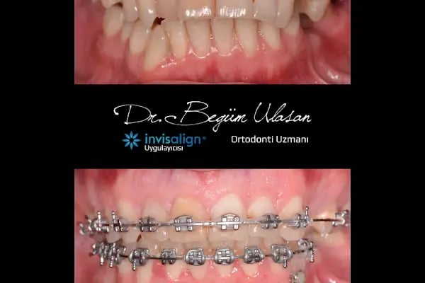 Ortodonti Uzmanı Dr. Begüm Ulaşan - Resim 12