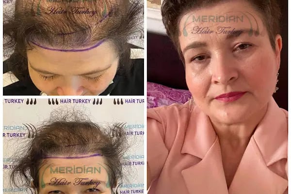 Meridian Hair Turkey - Resim 18