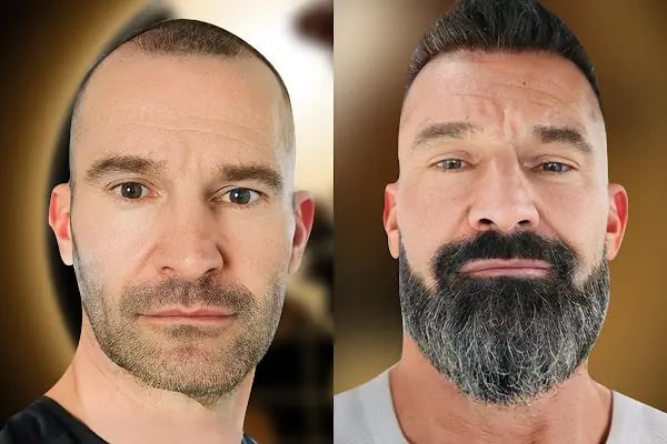 Asli Tarcan Clinic - Hair Transplant Turkey - Resim 3