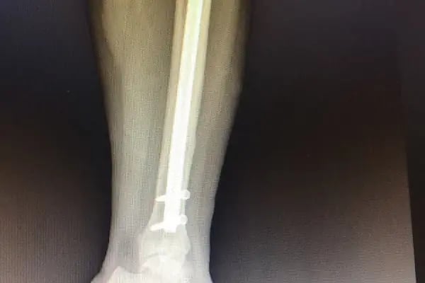 Op. Dr. Sercan Karadeniz, Ortopedi Ve Travmatoloji - Resim 14
