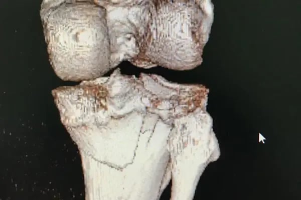 Op. Dr. Sercan Karadeniz, Ortopedi Ve Travmatoloji - Resim 11