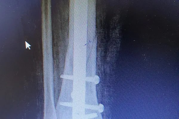 Op. Dr. Sercan Karadeniz, Ortopedi Ve Travmatoloji - Resim 12