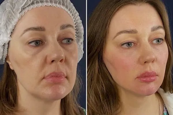 Op. Dr. Meltem Kılıç | İzmir Plastik, Rekonstrüktif ve Estetik Cerrahi | Aesthetics İzmir - Resim 7