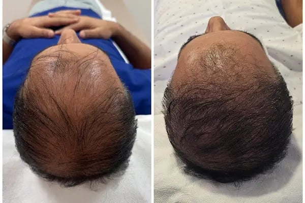 Ejem hair clinic- Saç Ekim merkezi - Resim 17