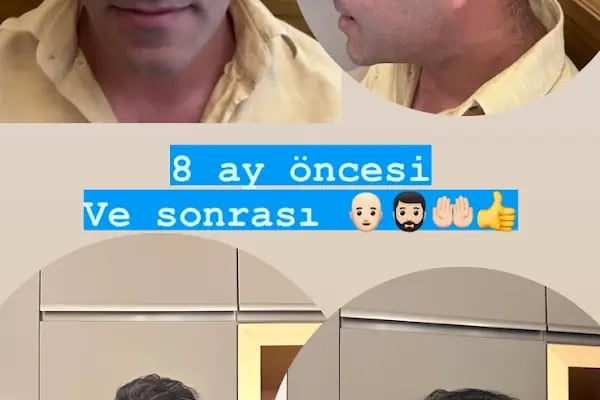 Ejem hair clinic- Saç Ekim merkezi - Resim 12