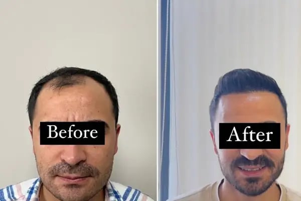 Ejem hair clinic- Saç Ekim merkezi - Resim 9