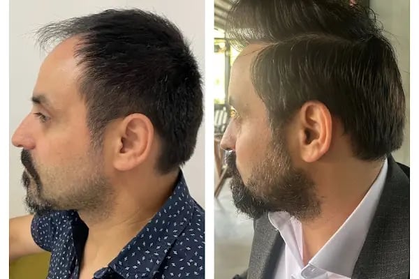 Ejem hair clinic- Saç Ekim merkezi - Resim 10