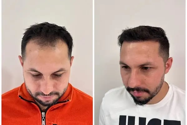 Ejem hair clinic- Saç Ekim merkezi - Resim 13