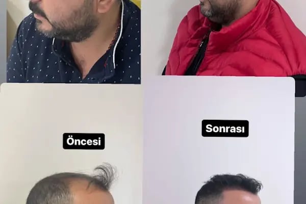 Ejem hair clinic- Saç Ekim merkezi - Resim 20