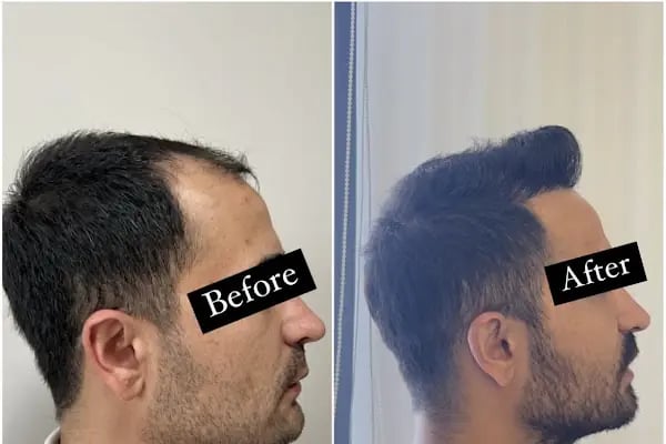 Ejem hair clinic- Saç Ekim merkezi - Resim 19