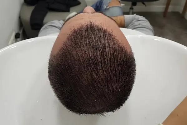 DK Klinik (Dermatology and Hair Transplant Antalya) - Resim 17