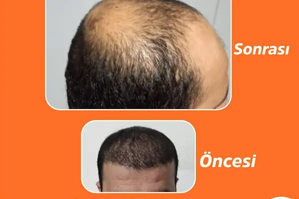 Dr Hair Clinic Saç Ekim merkezi - Resim 3