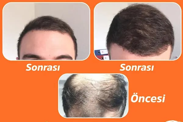 Dr Hair Clinic Saç Ekim merkezi - Resim 6
