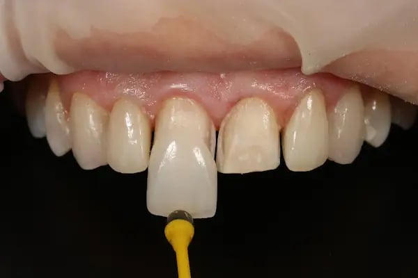DentArt Klinik Adana Diş Kliniği Diş Hekimi Gülüş Tasarımı İmplant Estetik Diş Hekimliği Adana Diş Beyazlatma - Resim 2