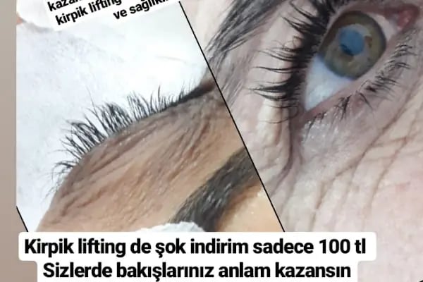 Op. Dr. Özcan Öcük - Estetik &amp; Plastik Cerrahi - Resim 14
