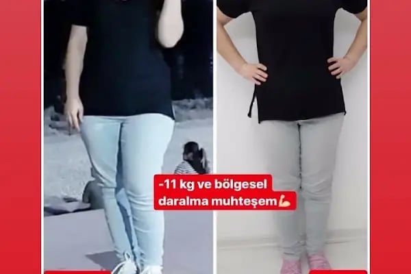 Op. Dr. Özcan Öcük - Estetik &amp; Plastik Cerrahi - Resim 16