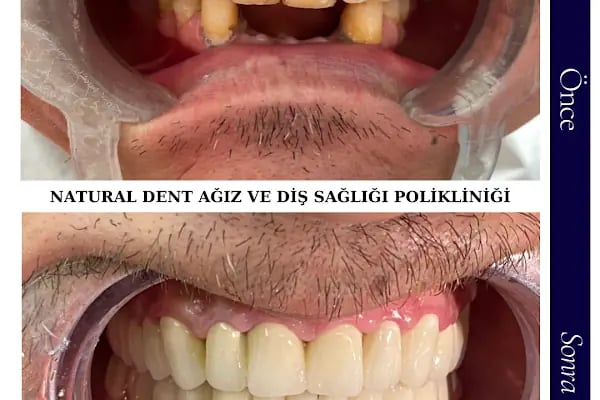 Natural Dent Ağız ve Diş Sağlığı Polikliniği Gaziantep - Resim 9