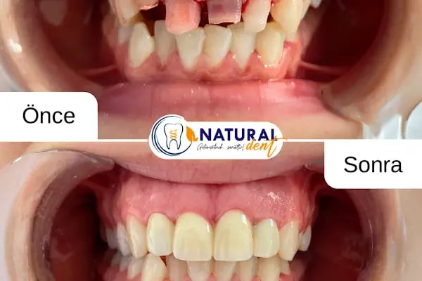 Natural Dent Ağız ve Diş Sağlığı Polikliniği Gaziantep - Resim 6