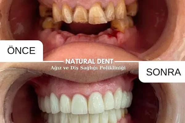 Natural Dent Ağız ve Diş Sağlığı Polikliniği Gaziantep - Resim 8