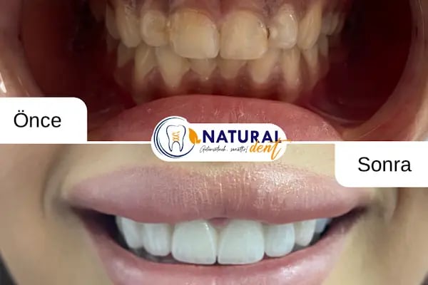 Natural Dent Ağız ve Diş Sağlığı Polikliniği Gaziantep - Resim 7