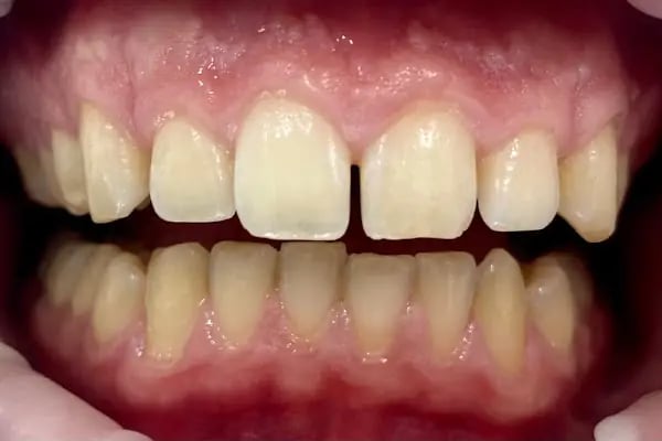 Mandarindent - Bodrum Diş Kliniği – Diş Tedavileri – Diş İmplantı – Estetik Diş Hekimliği - Resim 19