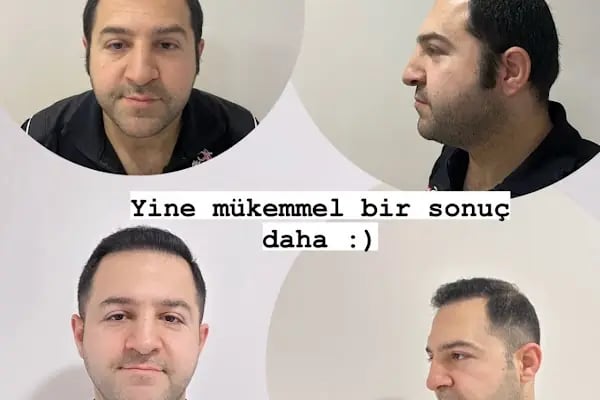 Gaziantep Saç Ekim&amp;Protez - Fue Estetik - Resim 8