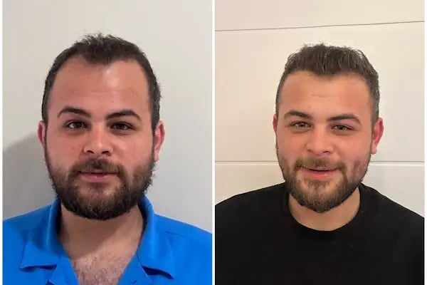 Gaziantep Saç Ekim&amp;Protez - Fue Estetik - Resim 17