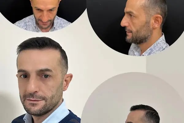 Gaziantep Saç Ekim&amp;Protez - Fue Estetik - Resim 16
