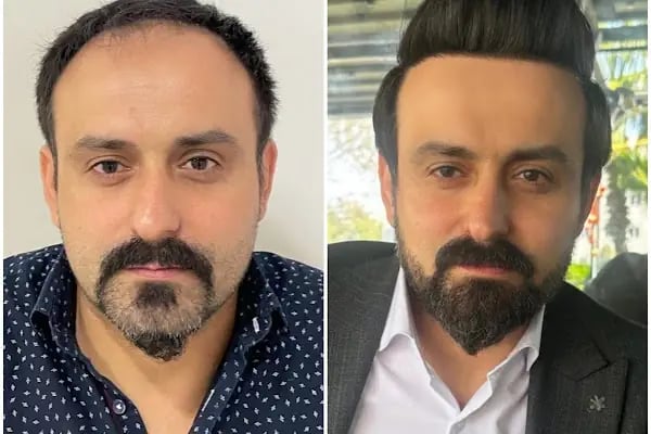 Gaziantep Saç Ekim&amp;Protez - Fue Estetik - Resim 6