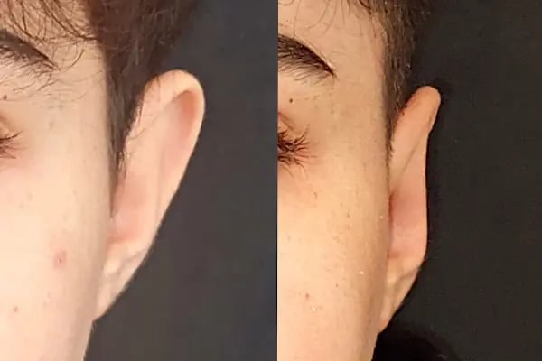 Doç.Dr.Alper Ural Plastik Rekonstrüktif ve Estetik Cerrahi - Resim 8