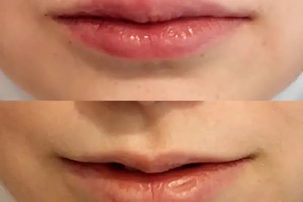 Doç.Dr.Alper Ural Plastik Rekonstrüktif ve Estetik Cerrahi - Resim 11
