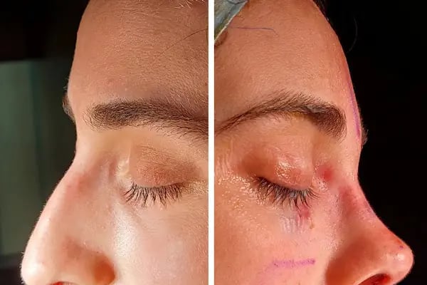 Doç.Dr.Alper Ural Plastik Rekonstrüktif ve Estetik Cerrahi - Resim 5